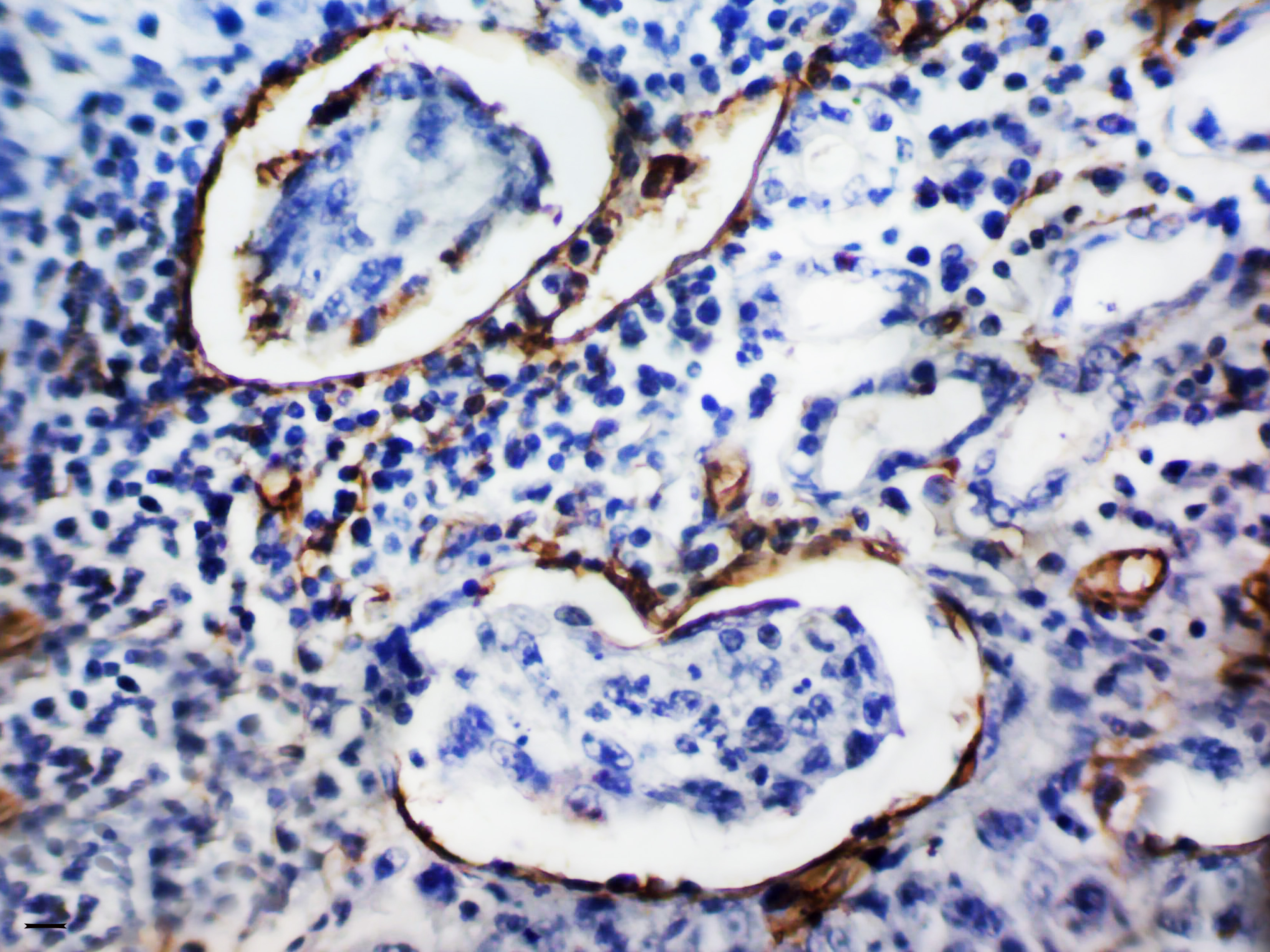 Adenocarcinoma de estómago altamente diferenciado (T3N1M0, G1)